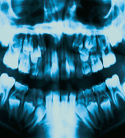Cavity Treatment